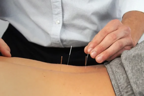 Acupuncture treatment